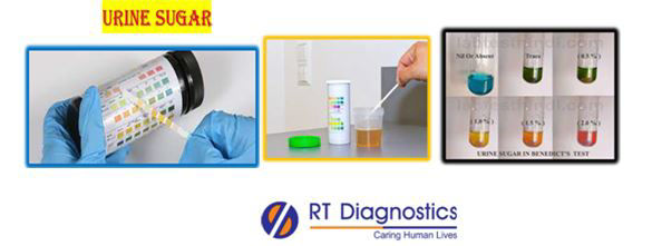 Urine for sugar test